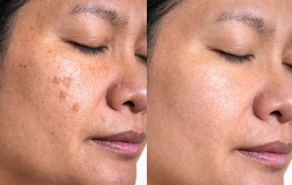 Woman with eyes closed, showing her skin before and after age spot laser treatment in side by side photos