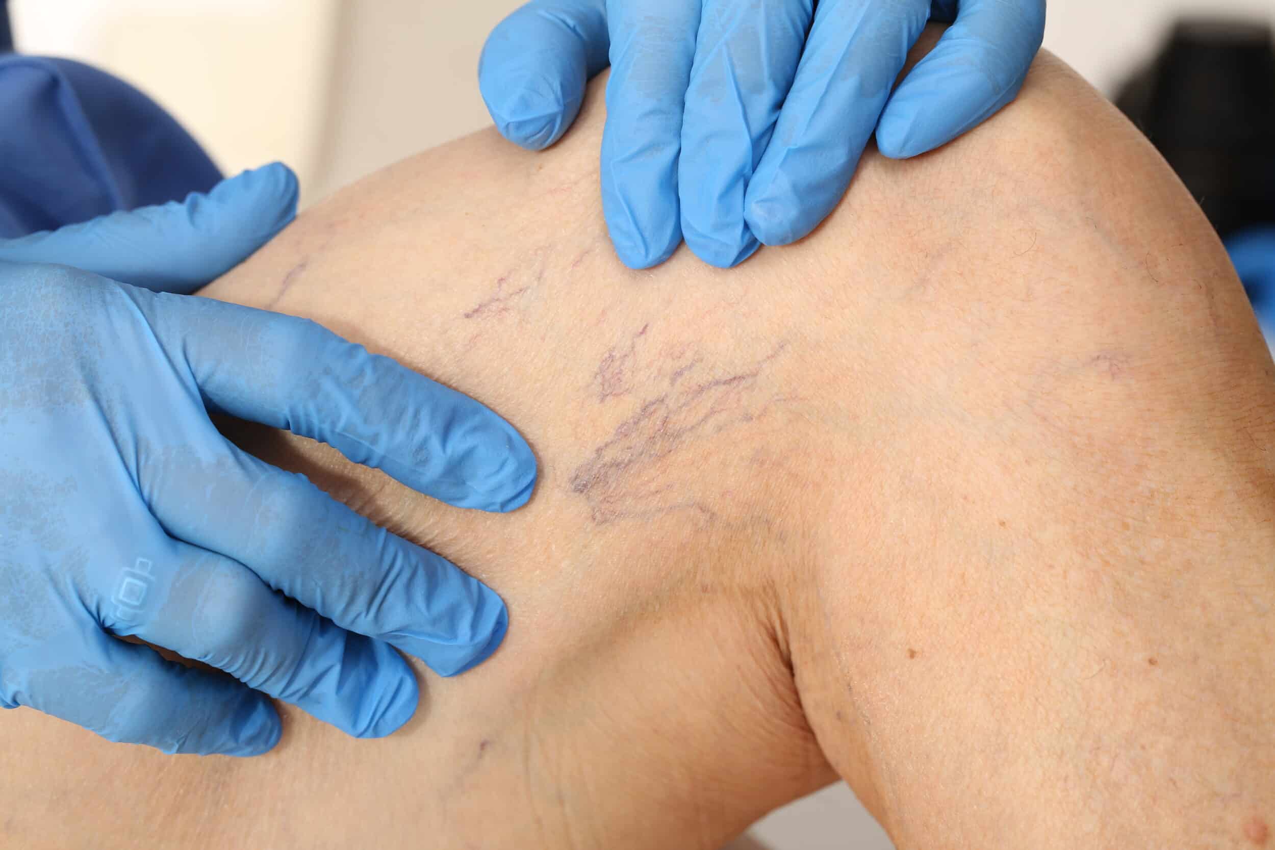 A gloved hand points to small spider veins on a woman's upper leg