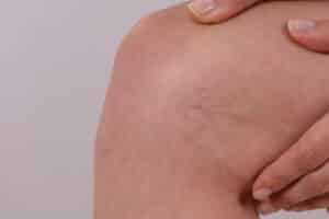 Close up of a woman’s leg with tiny spider veins before undergoing laser therapy and sclerotherapy